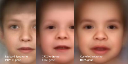 Costello Syndrome, Leopard Syndrome, and Noonan Syndrome