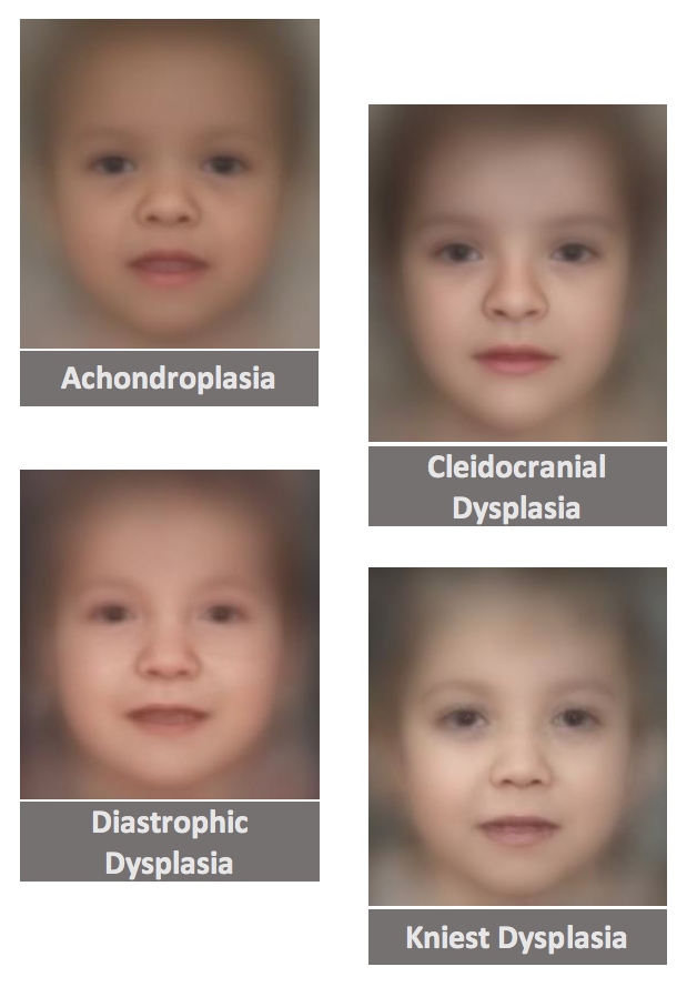 Skeletal Dysplasias