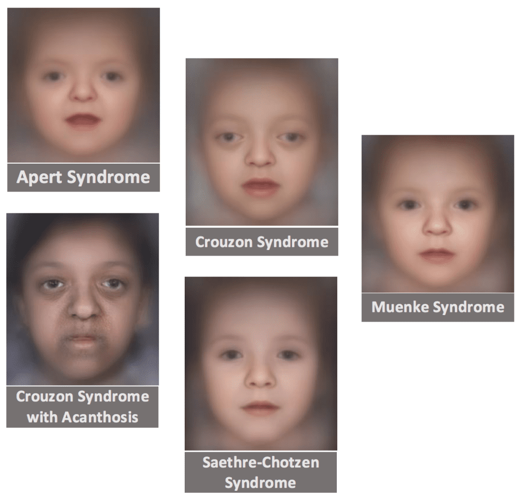 FDNA™ - Discovered Craniosynostosis in FDNA Year of Discovery