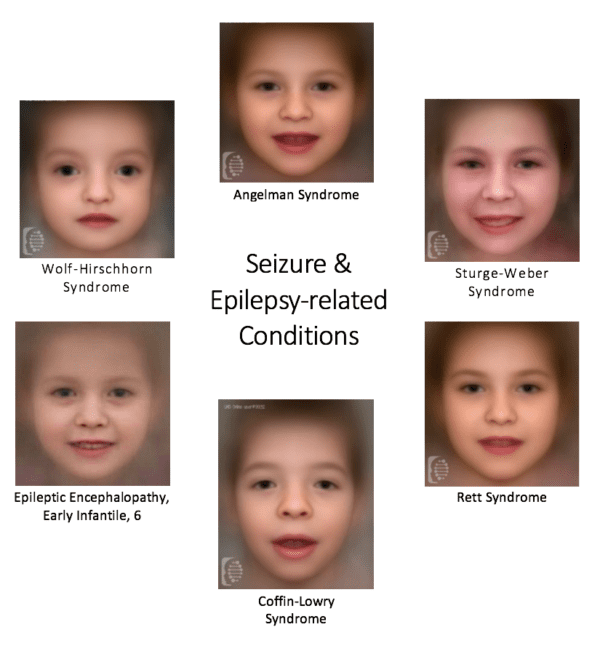 FDNA™ - Seizure and Epilepsy Related Disorders in the Year of Discovery