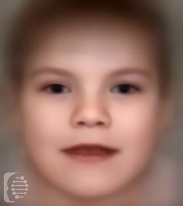 Simpson Golabi Behmel Syndrome OMIM 312870 FDNA Simpson Golabi Behmel Syndrome OMIM 312870 FDNA