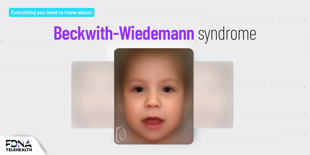 FDNA™ Wiedemann Syndrome: Symptoms, Causes, and Diagnosis