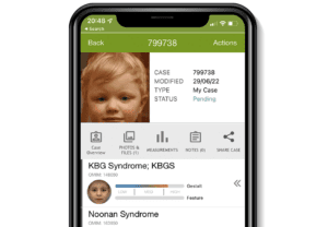 Diagnostic Odyssey of KBG syndrome